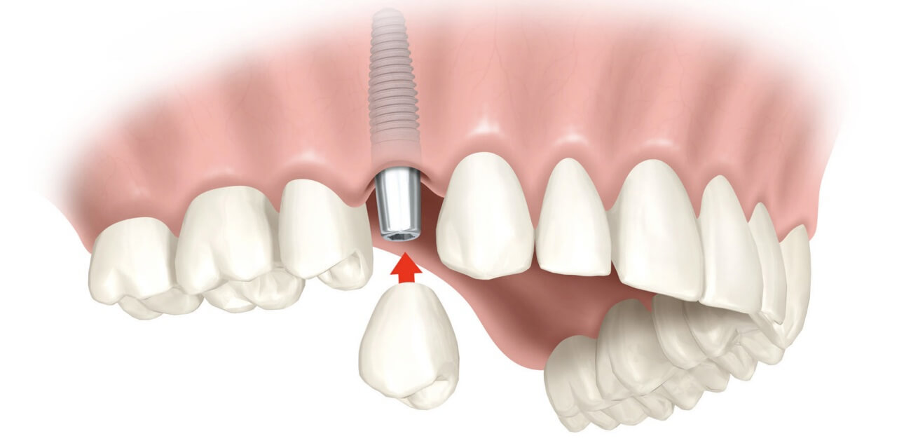 Implante Dentário em santos