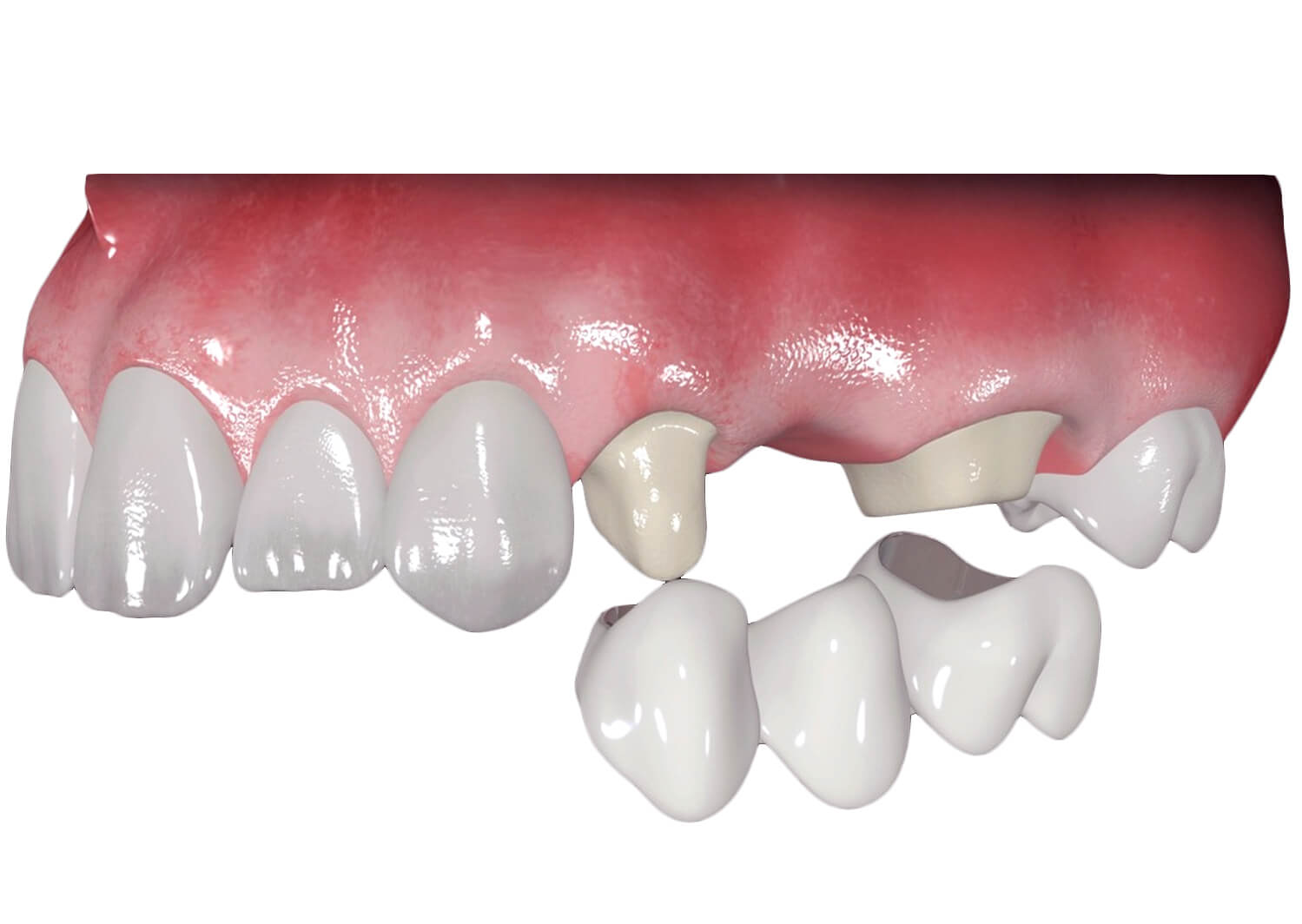Prótese Dentária em cubatão